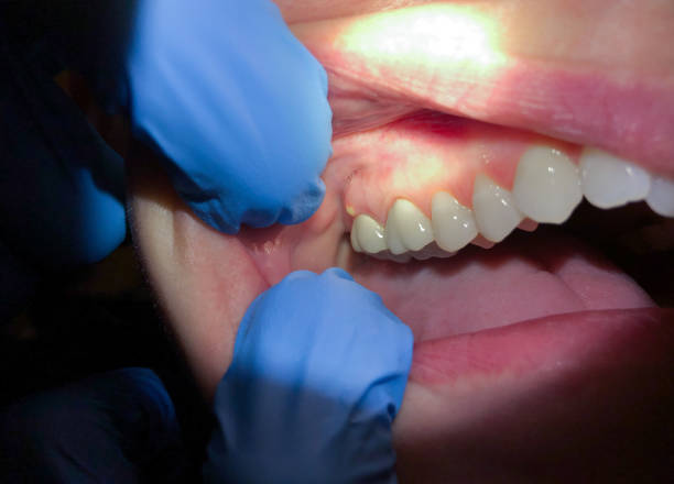 Best Emergency Tooth Extraction in Woodway, TX
